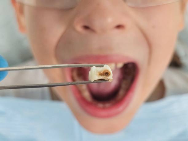 Best Emergency Treatment for Toothache in Broadview, IL